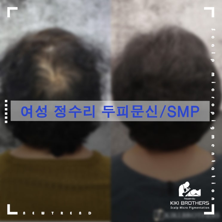  정수리탈모, 이렇게 달라집니다. 탈모커버 전문 두피문신/SMP 전문샵 키키브라더스 노원