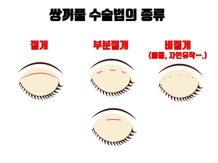  절개 쌍수도 아니고 자연유착 쌍수도 아닌 부분 절개는 대체 뭔가요?
