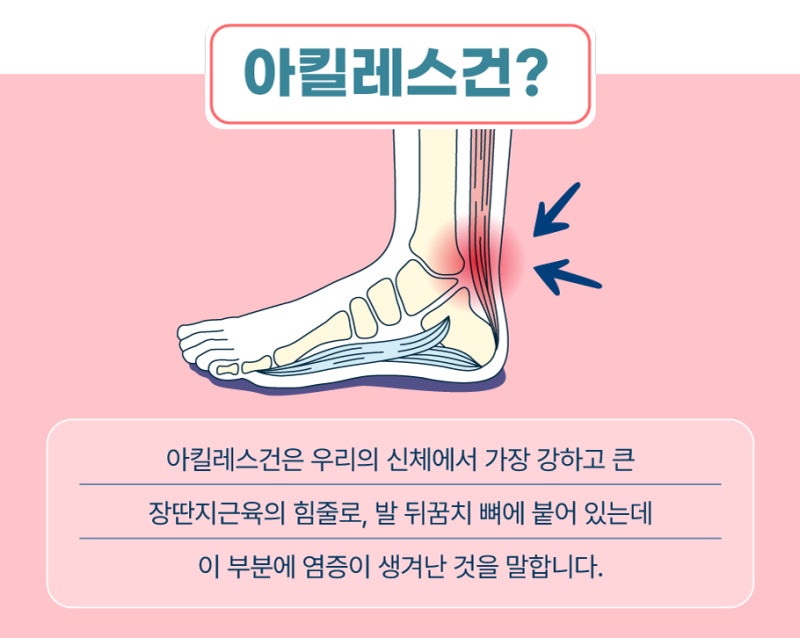 논현역신경외과, 아킬레스건에 통증이
