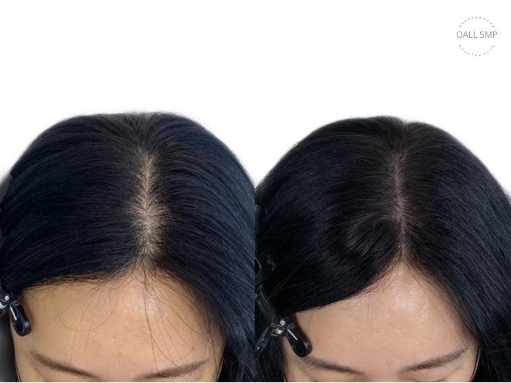 [OALL Scalp studio] 여성 탈모 가르마 smp시술