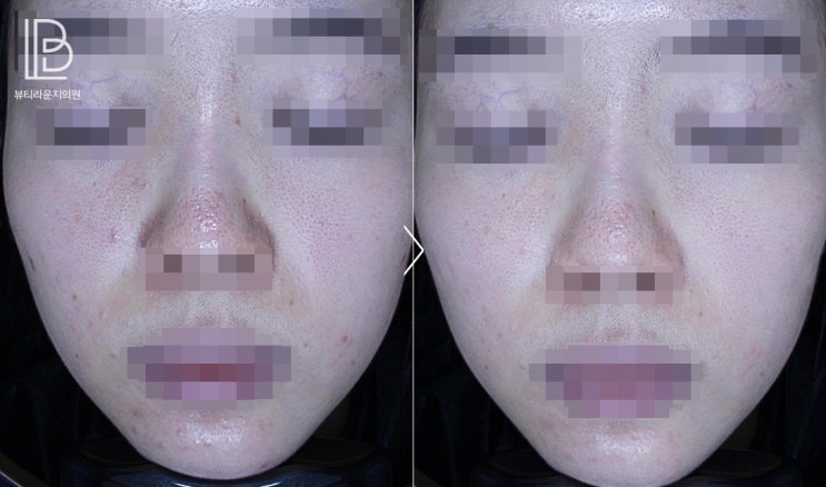  뷰티라운지의원하남 난치성 좁쌀 여드름 고민 해결 방법