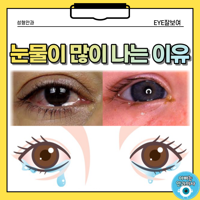  눈물이 많이 나는, 흐르는 이유 - 자꾸 눈물이 나요.