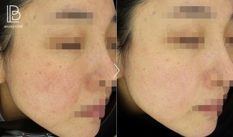  뷰티라운지의원잠실 여드름 치료의 후유증, 색소침착에는 어떤 치료를 해야 할까