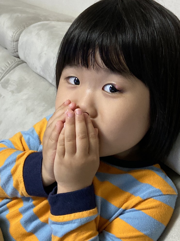  5살 유아 다래끼, 수술 없이 집에서 셀프 완치! (콩다래끼/ 온찜질/ 안약/ 안연고