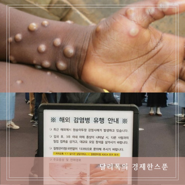  원숭이두창 전염 증상 3주만에 4백명대 WHO 2단계 보통위험 격상