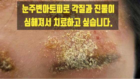  눈주변아토피로 각질과 진물이 심해져서 치료하고 싶습니다.