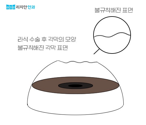 라식 라섹 (수술) 후 렌즈 껴도 되나요? : 네이버 블로그 라식 라섹 (수술) 후 렌즈 껴도 되나요? : 네이버 블로그