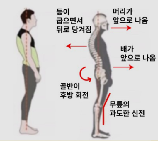  [비포&애프터] 배를 내밀고 서 있다면 '스웨이백 Sway back'을      의심해보세요!