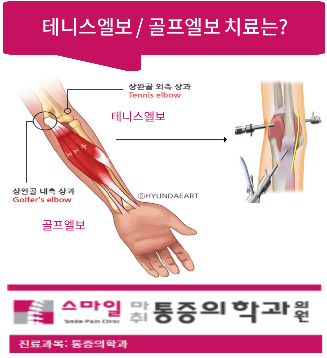  [일산팔꿈치통증치료병원] 테니스엘보. 골프엘보 치료법