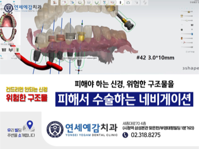  충정로 내비게이션 임플란트 알려드려요