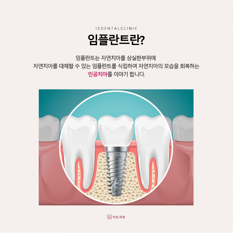 치아를 복원하고 싶다면 동탄치과 임플란트