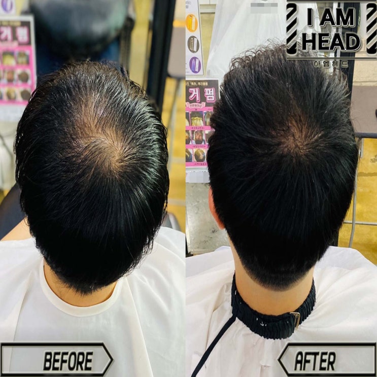  { 수원링거펌} 탈모커버엔 역시! 링거펌이죠!