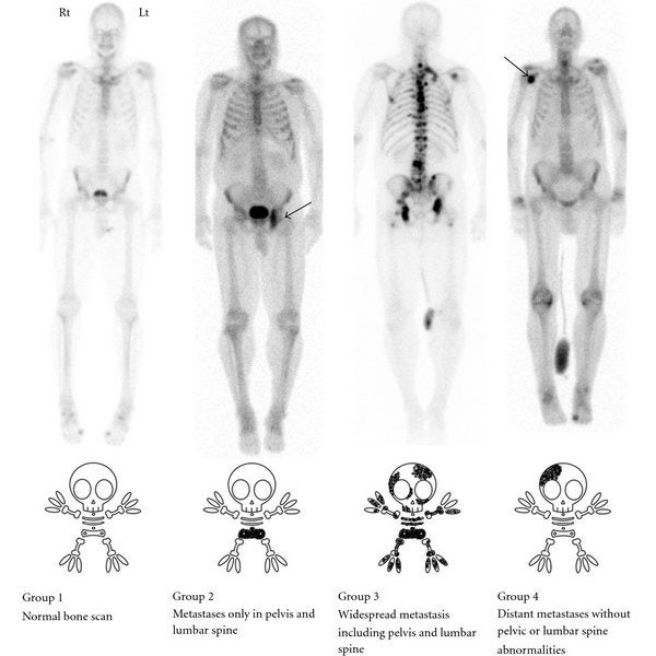 Bone scan 뼈스캔 본스캔 검사란? 검사 준비사항, 검사방법, 검사 후 주의사항, 비용 : 네이버 블로그