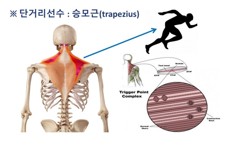  상지교차증후군 upper crossed syndrome, 거북목증후군, 근막통증증후군 myofascial pain syndrome