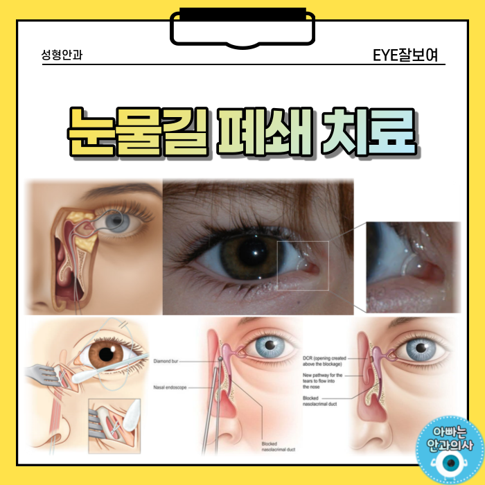  자꾸 눈물이 나요, 눈물흘림 치료(2)- 실리콘관삽입, 눈물주머니코안연결