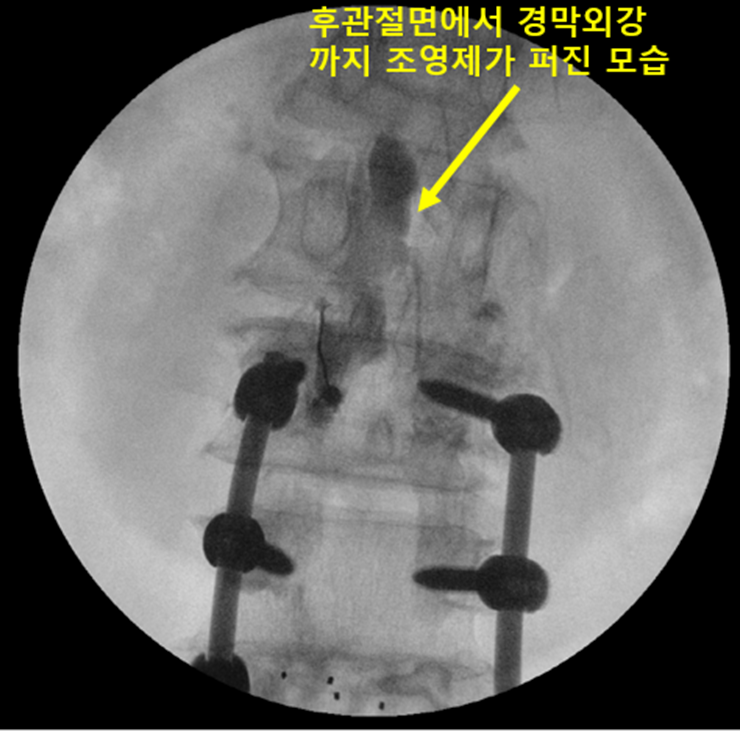  장분절 요추 유합술 후의 허리통증, 다리통증의 치료 (인접부위질환)