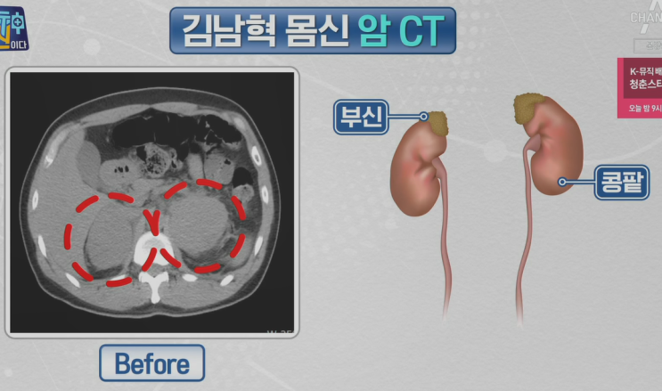  버킷림프종 4기 이겨낸 방법