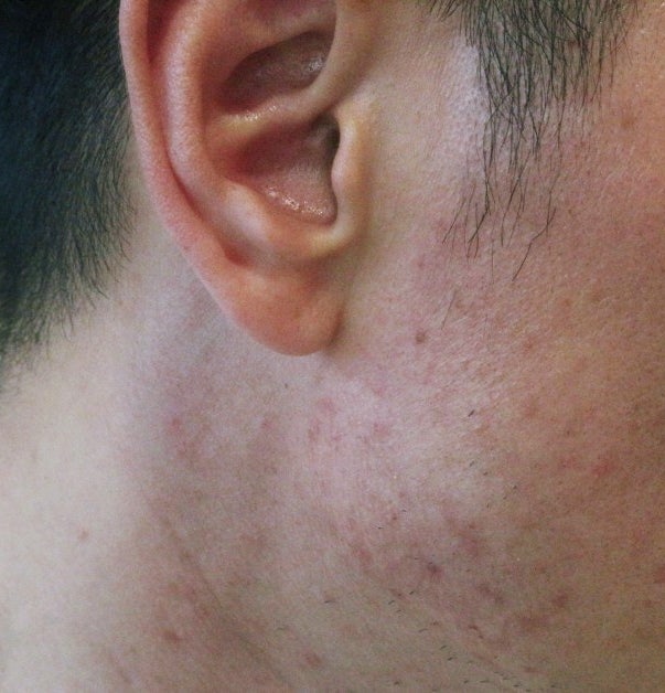 턱 뾰루지 피지 모낭염 원인 야무진 관리 방법