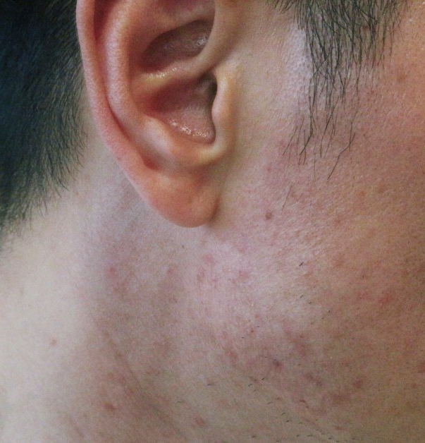 턱 뾰루지 피지 모낭염 원인 야무진 관리 방법 턱 뾰루지 피지 모낭염 원인 야무진 관리 방법