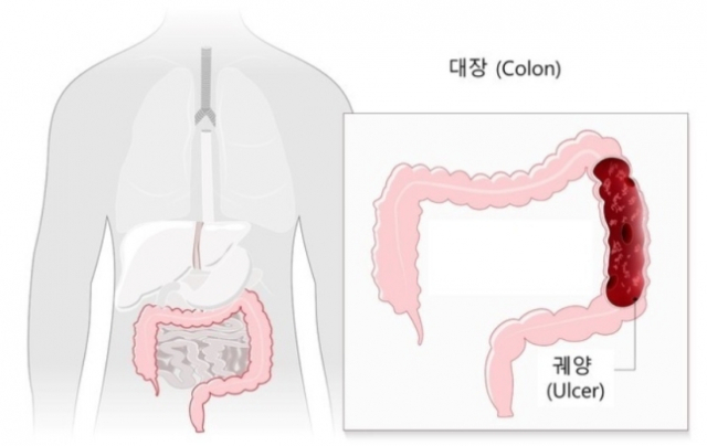 대장암 위험 신호…'이 증상' 가볍게 보면 큰일 난다