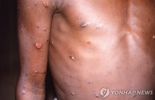 "대부분 동성·양성애 남성"…캐나다 원숭이두창, 보름만에 15배↑ "대부분 동성·양성애 남성"…캐나다 원숭이두창, 보름만에 15배↑