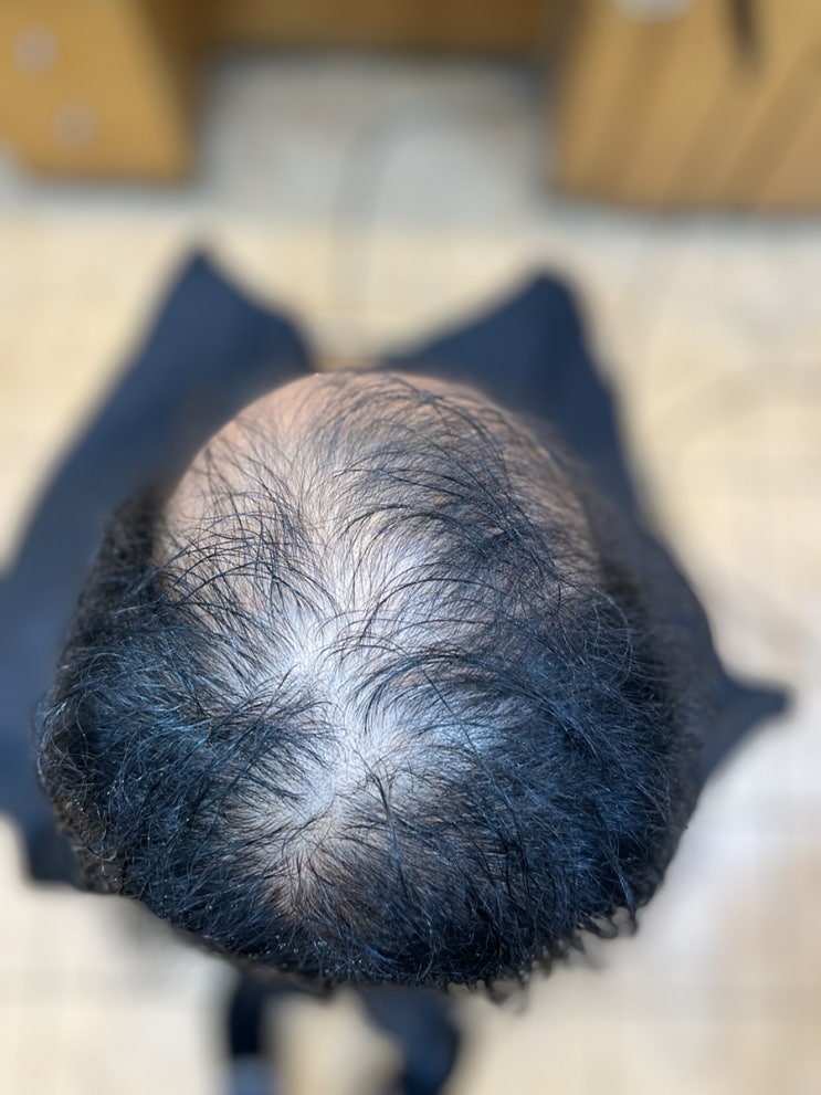  꿈은 이루어지는거다! 탈모대머리 풍성하게 보이고 싶다 그럼 바로 여기로!부산사상탈모관리및 커버펌전문미용실/ 경주밀양거제녹산덕계울산양산대구창원마산장유기장명지장림