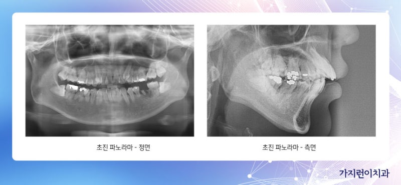 직렬조합교정으로 튀어나온 입모양이 개선되었습니다!