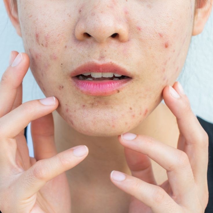 코 뾰루지 원인 밑 옆 코에 자꾸 난다면? 코 뾰루지 원인 밑 옆 코에 자꾸 난다면?