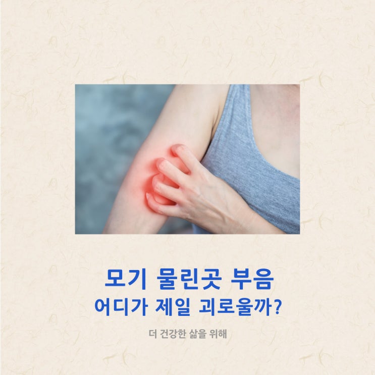 모기 물린곳 부음 어디가 제일 괴로울까?