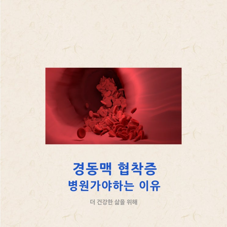 경동맥 협착증 병원가야하는 이유