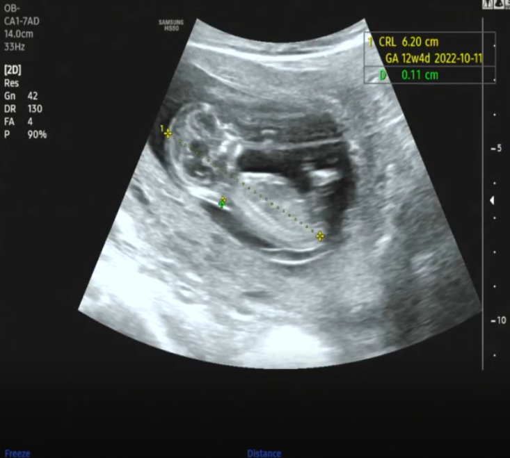 임신 12주 16주 초음파 사진 드디어 성별 확인 둘째 임신일기 (2)