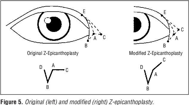  고식적 피부판 앞트임수술 방법들(methods of conventional skin flap epicanthoplasty) vs 진화생물학적 윗트임