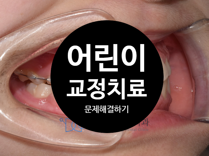 하남 어린이 부정교합 교정에서 발생 가능한 문제 해결하기! Mini tube appliance; MTA 교정