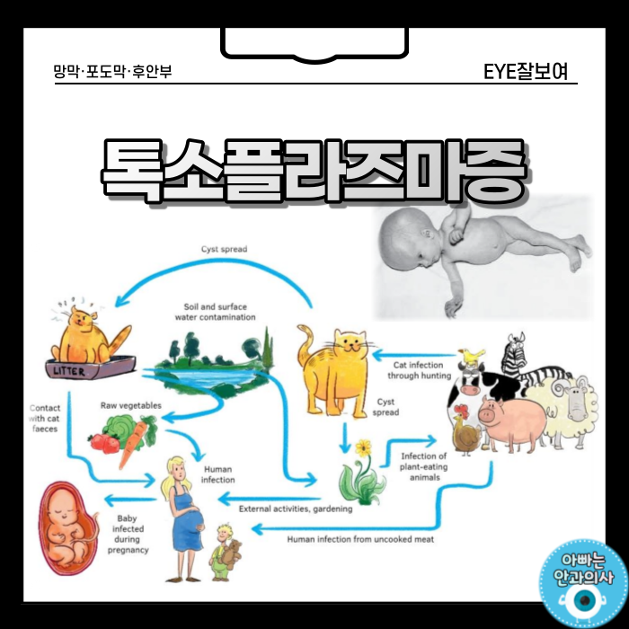  '톡소플라즈마증'의 종류