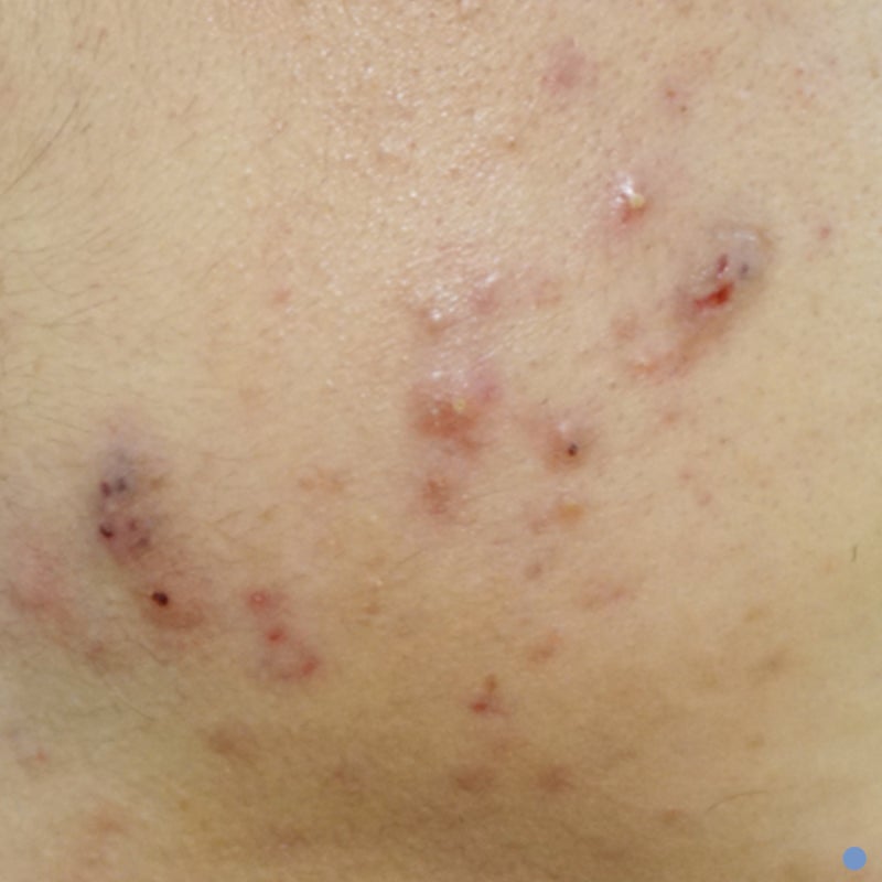귀뒤피지낭종 덩어리가 볼록하게 올라온 이유는? : 네이버 블로그 귀뒤피지낭종 덩어리가 볼록하게 올라온 이유는? : 네이버 블로그