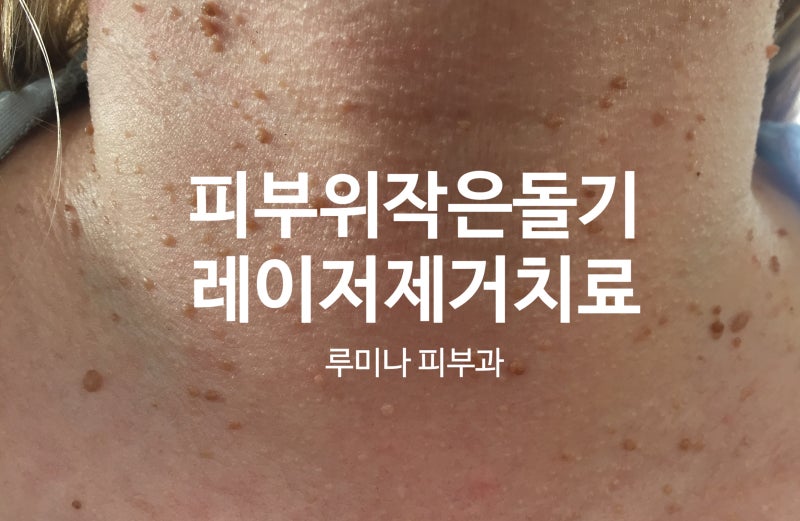 용인수지피부과_작은 돌기 한관종, 쥐젖, 편평사마귀 레이저제거 치료