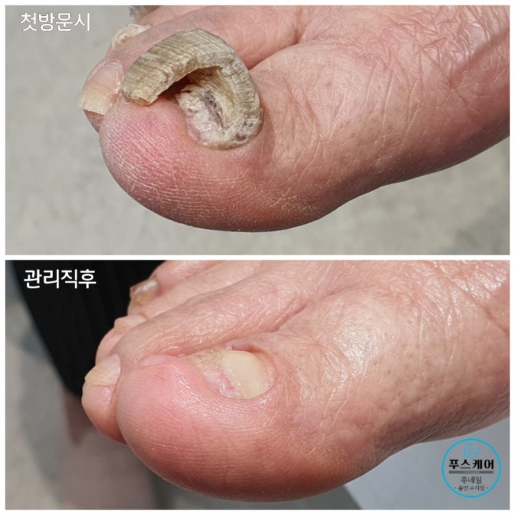82세 할머니의 두껍고 비정상적으로 자란 무좀 변형발톱 제거 1회 관리후기/성남수원수지보정동백죽전동/주네일/네일샵무좀파고드는내향성발톱손톱변형푸스케어 82세 할머니의 두껍고 비정상적으로 자란 무좀 변형발톱 제거 1회 관리후기/성남수원수지보정동백죽전동/주네일/네일샵무좀파고드는내향성발톱손톱변형푸스케어