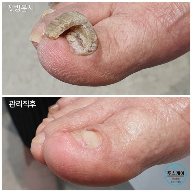 82세 할머니의 두껍고 비정상적으로 자란 무좀 변형발톱 제거 1회 관리후기/성남수원수지보정동백죽전동/주네일/네일샵무좀파고드는내향성발톱손톱변형푸스케어