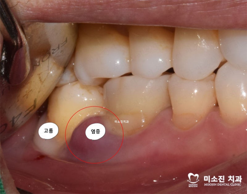 잇몸 피부의 염증을 해결하기 위해서는