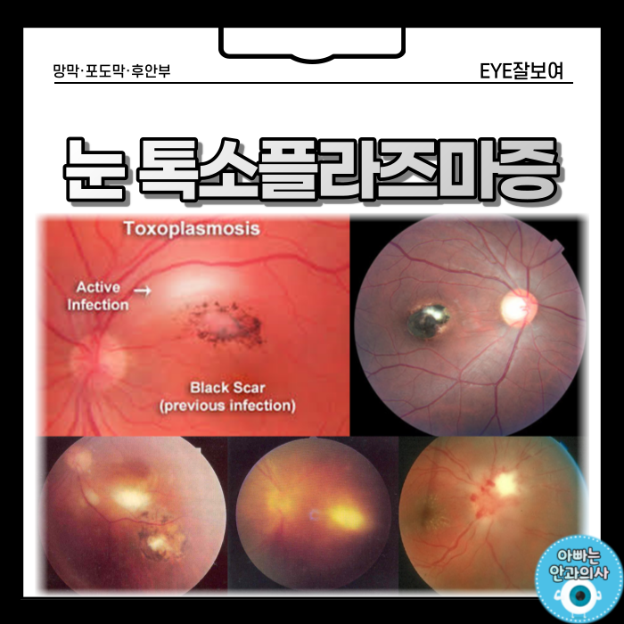  고양이 기생충이 눈에 감염을?! - '눈톡소플라즈마증'