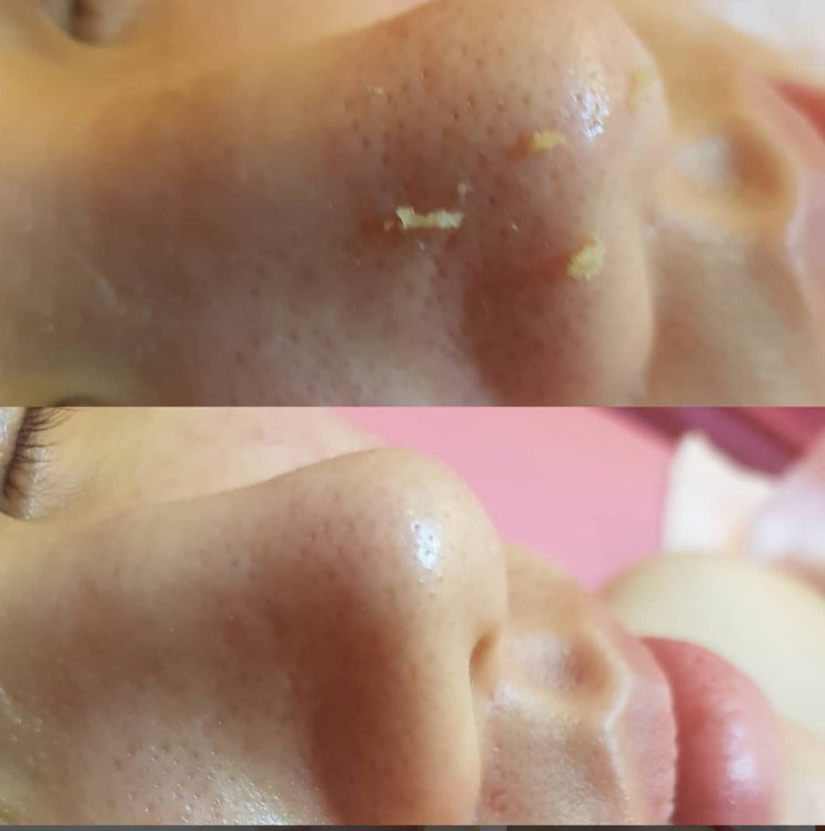  메이크업 찌꺼기 제거, 화장으로 쌓인 모공 노폐물 청소