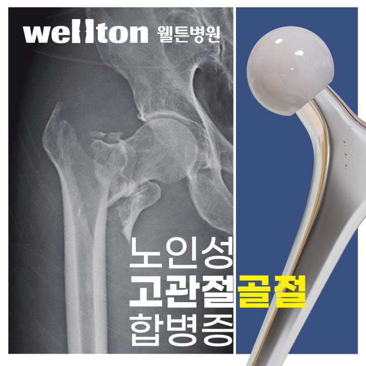  [고관절병원] 노인고관절골절 심할경우 합병증발생