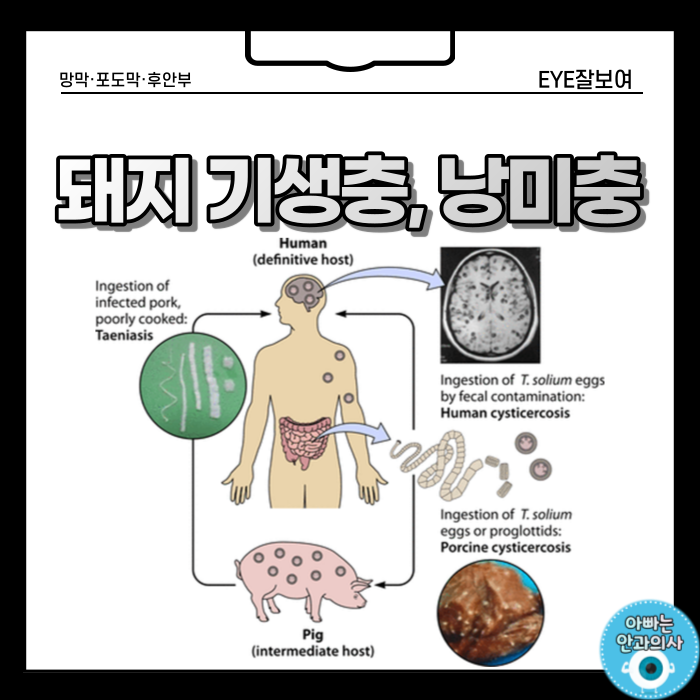 익히지 않은 돼지고기는 위험해!! - 낭미충(유구낭미충, 유구조충)