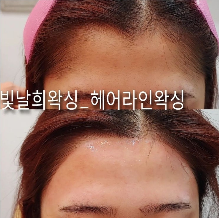  답답한이마 앞머리로 가리지 마시고 헤어라인왁싱으로 여신이마완성