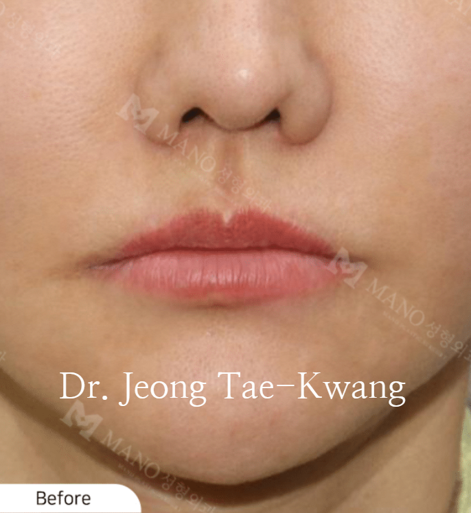 내려간 입꼬리 스트레스를 올리기 수술로 해결 : 네이버 블로그 내려간 입꼬리 스트레스를 올리기 수술로 해결 : 네이버 블로그