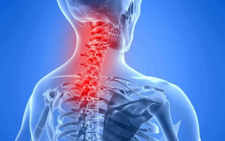목뼈 UCM 이론 2편 / 척추원반 퇴행 분절의 손상 단계