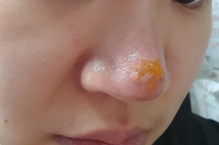  얼굴대상포진 치료기① - (5.31~6.2) 대상포진 초기 증상