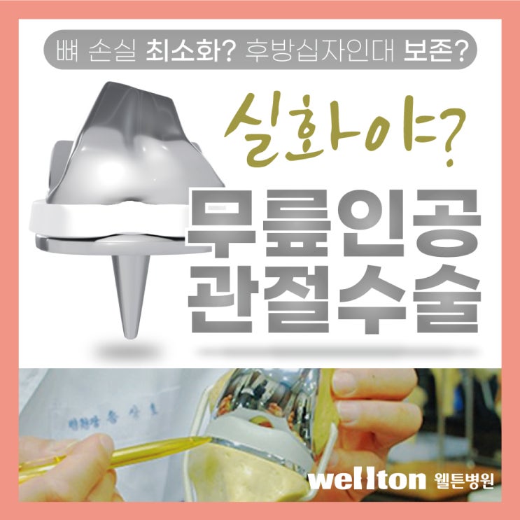  마곡나루병원, 후방십자인대 보존하는 무릎인공관절수술