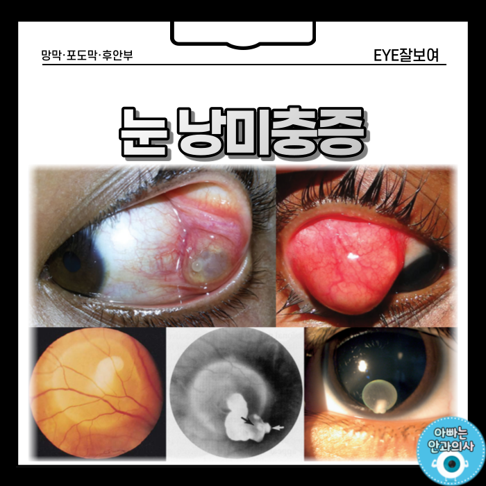  돼지고기 먹고 눈이 잘 안보인다? - 눈 낭미충증
