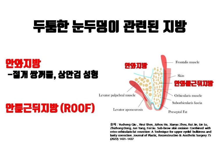  두툼한 눈두덩이 눈썹하거상과 동시에 눈두덩이지방제거로 가능해요!!!